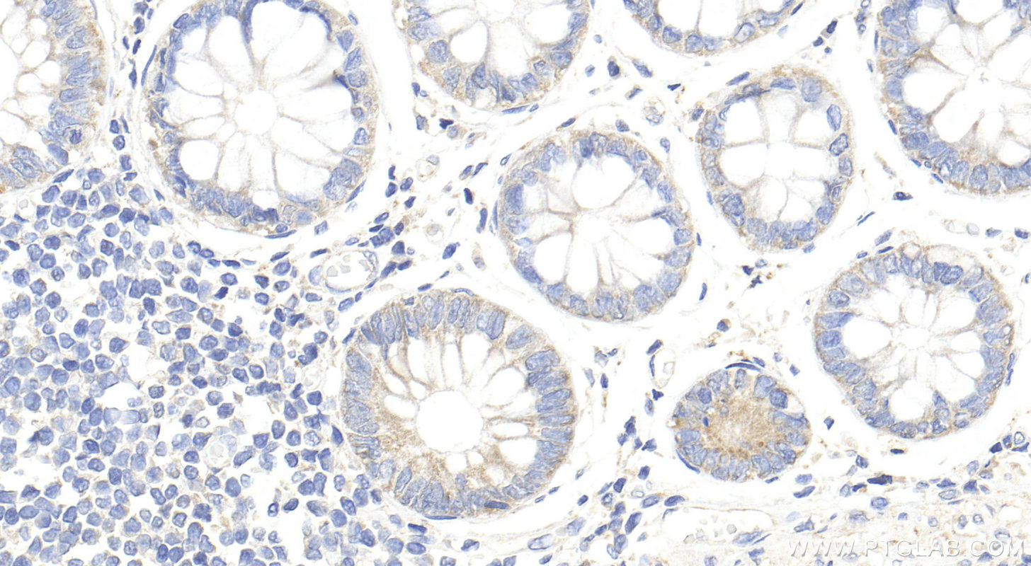 IHC staining of human rectal cancer using Biotin-25616