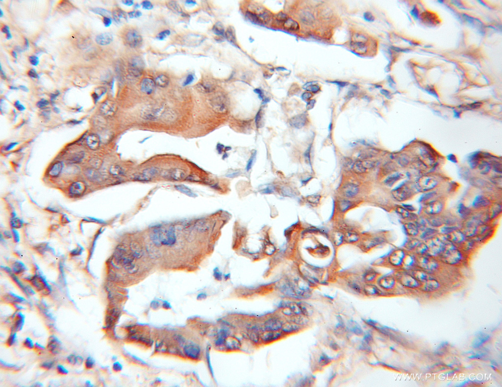 IHC staining of human colon cancer using 11735-1-AP (same clone as 11735-1-PBS)