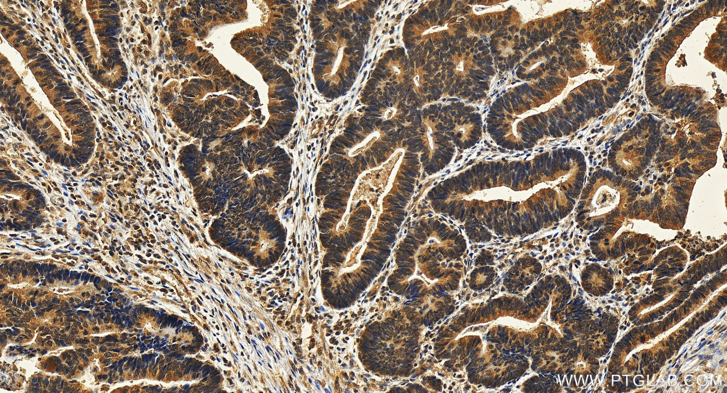 IHC staining of human colon cancer using 67494-1-Ig