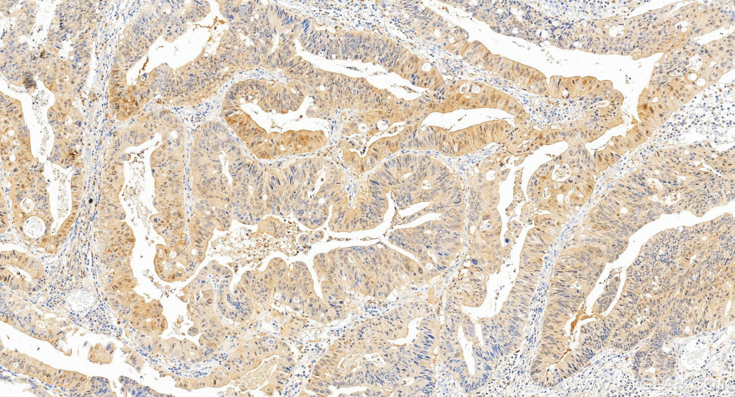 IHC staining of human colon cancer using 88328-1-RR