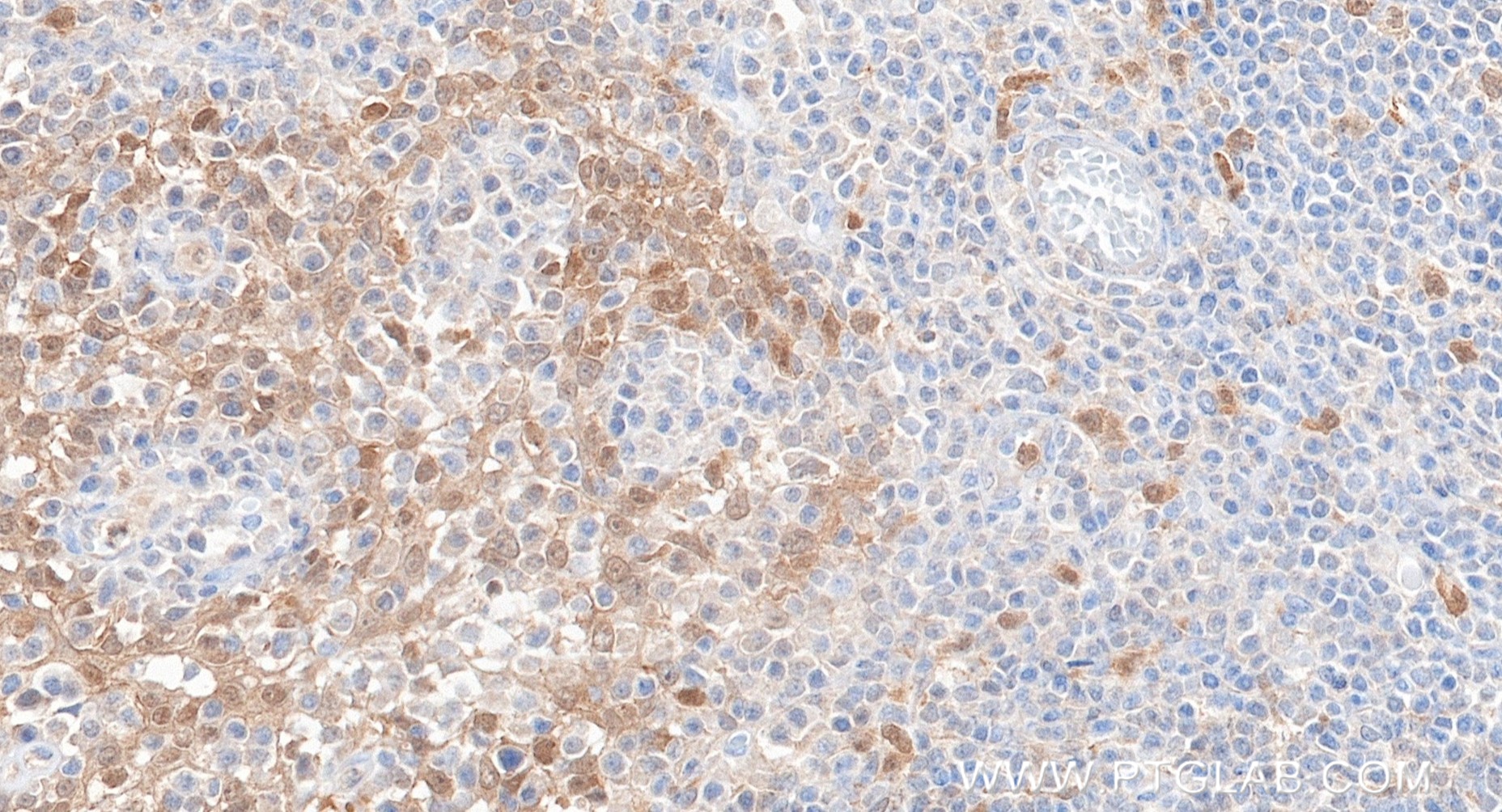 IHC staining of human tonsillitis using 88328-1-RR