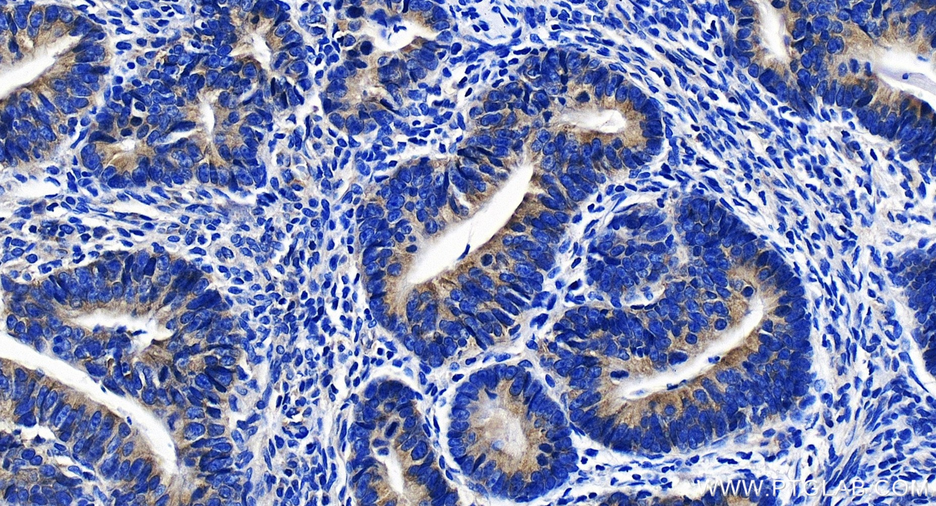IHC staining of human colon cancer using 86086-1-RR (same clone as 86086-1-PBS)