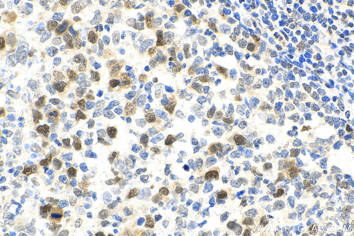 IHC staining of human lymphoma using 11011-1-AP (same clone as 11011-1-PBS)