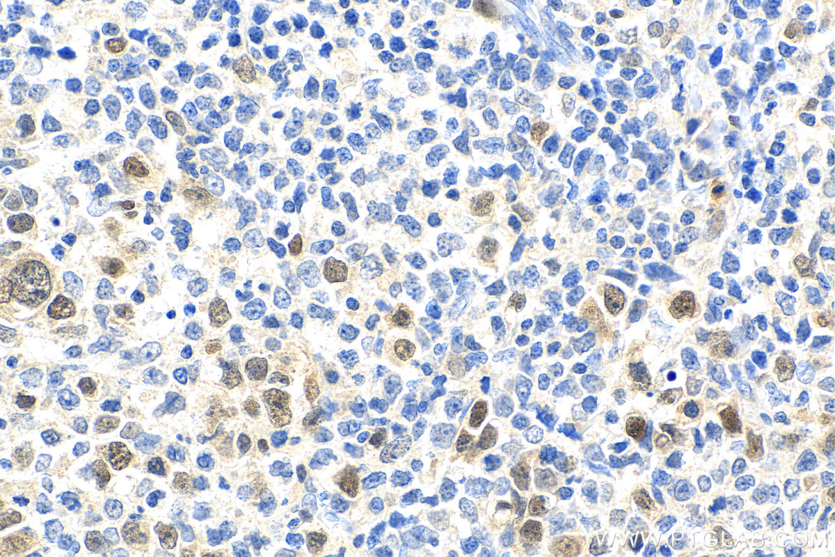 IHC staining of human lymphoma using 22258-1-AP