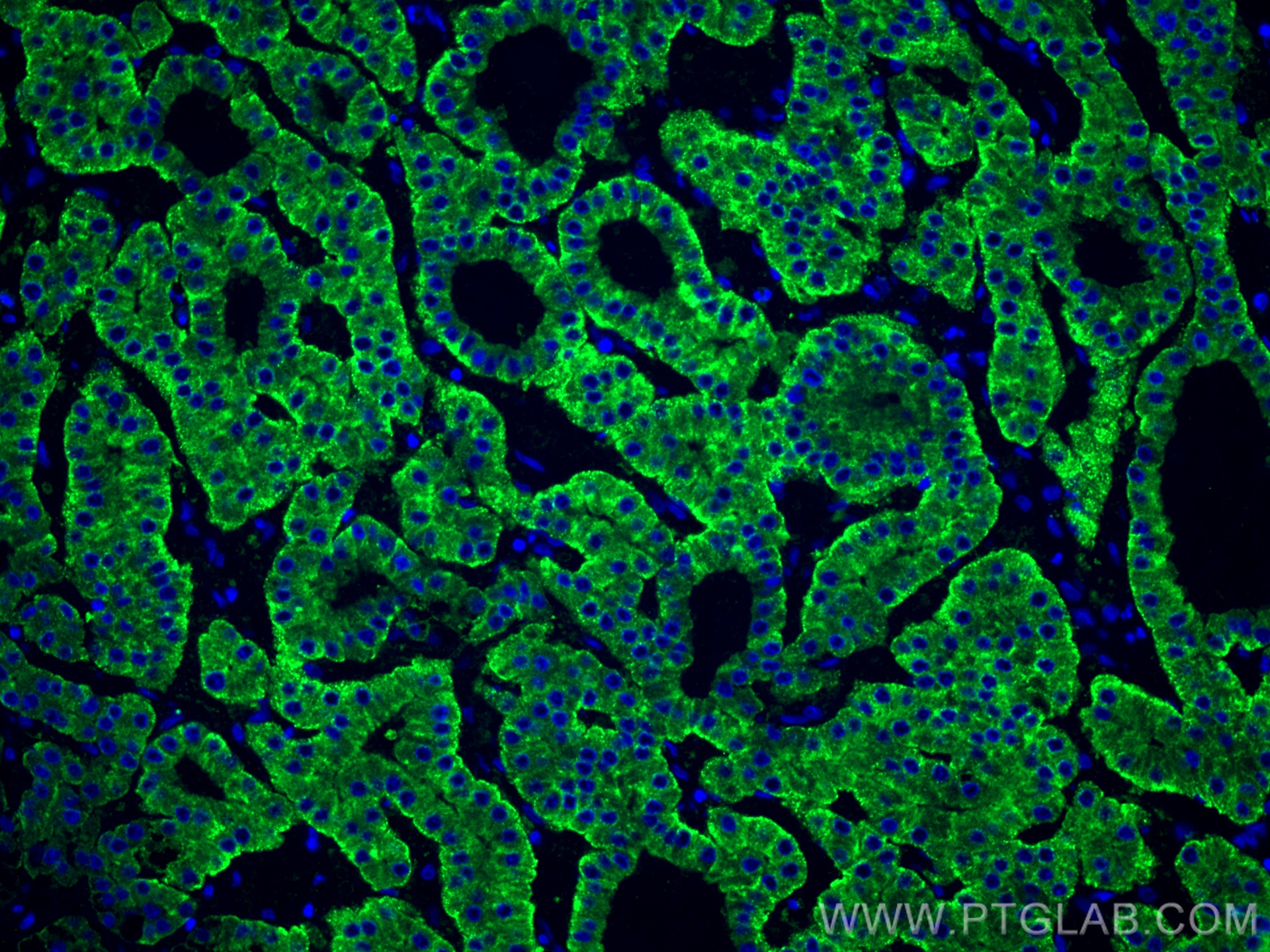 IF Staining of human liver cancer using 11739-1-AP