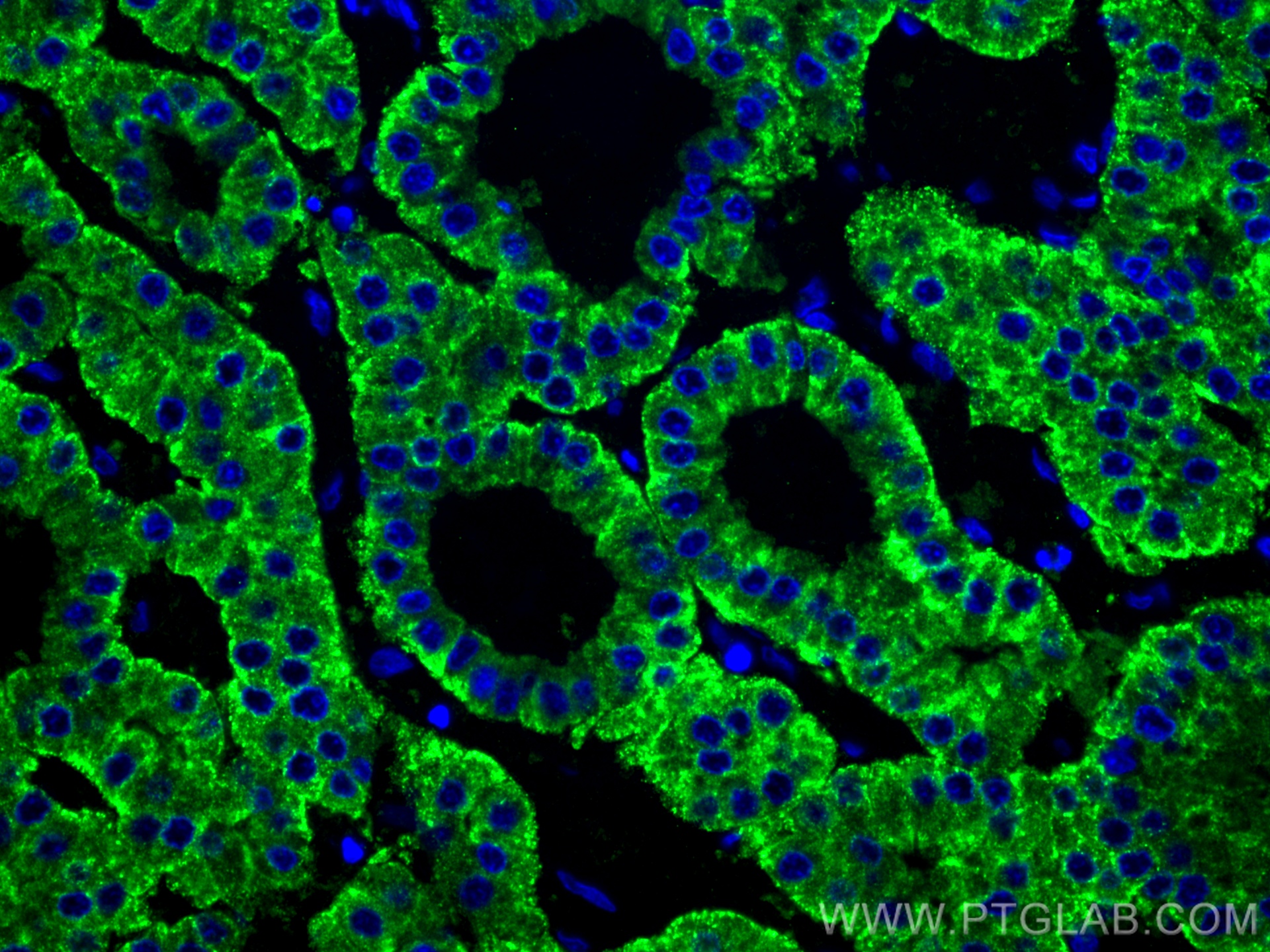 IF Staining of human liver cancer using 11739-1-AP