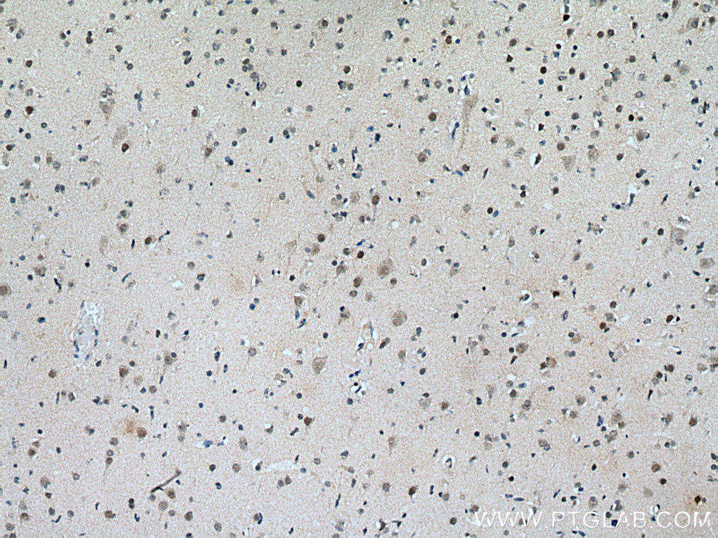 IHC staining of human gliomas using 12331-1-AP