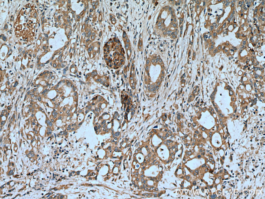 IHC staining of human pancreas cancer using 27235-1-AP