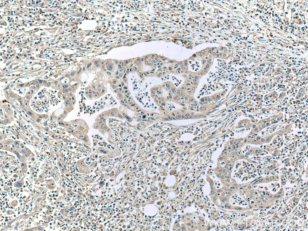 IHC staining of human pancreas cancer using 67072-1-Ig (same clone as 67072-1-PBS)