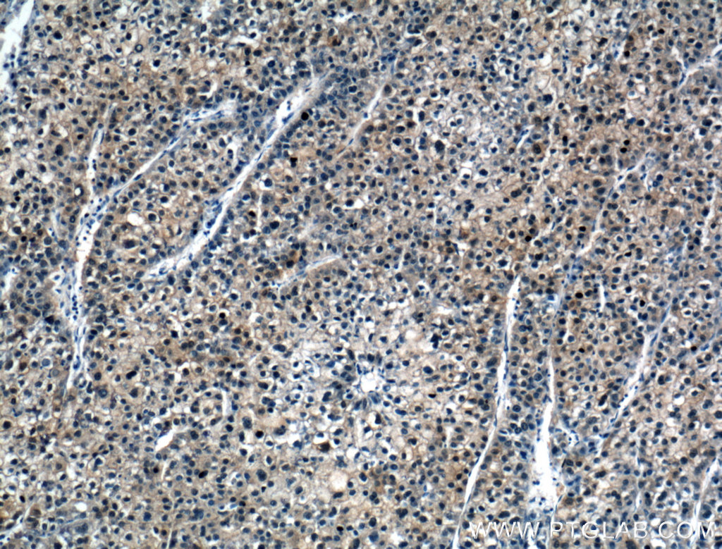 IHC staining of human liver cancer using 16645-1-AP