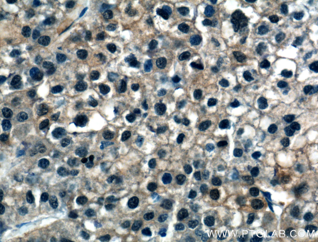 IHC staining of human liver cancer using 16645-1-AP