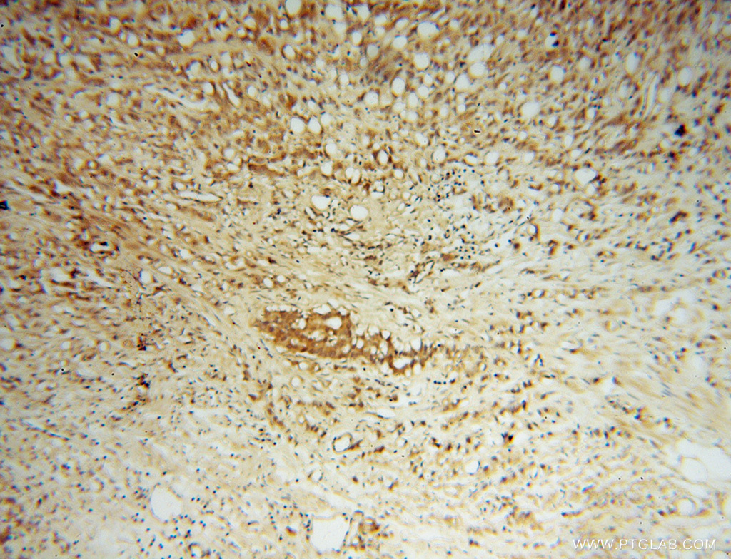 IHC staining of human prostate cancer using 14981-1-AP