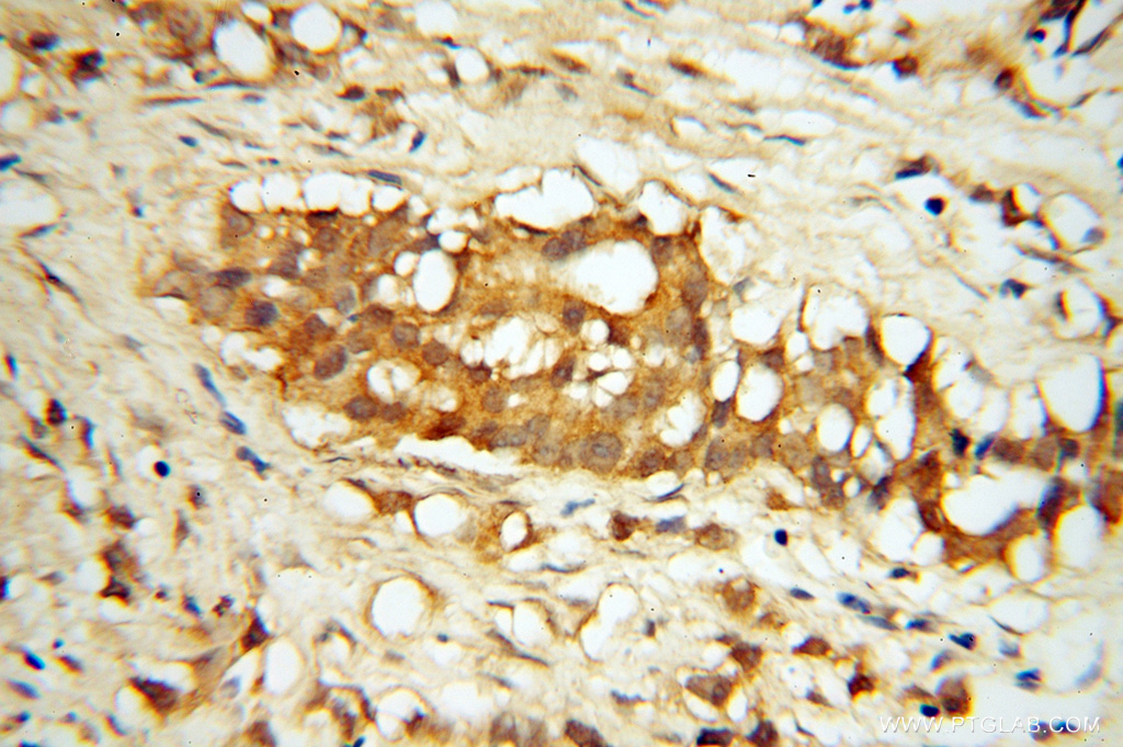 IHC staining of human prostate cancer using 14981-1-AP