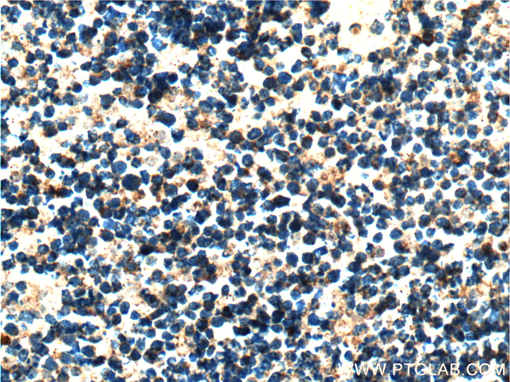 IHC staining of human retinoblastoma using 14681-1-AP