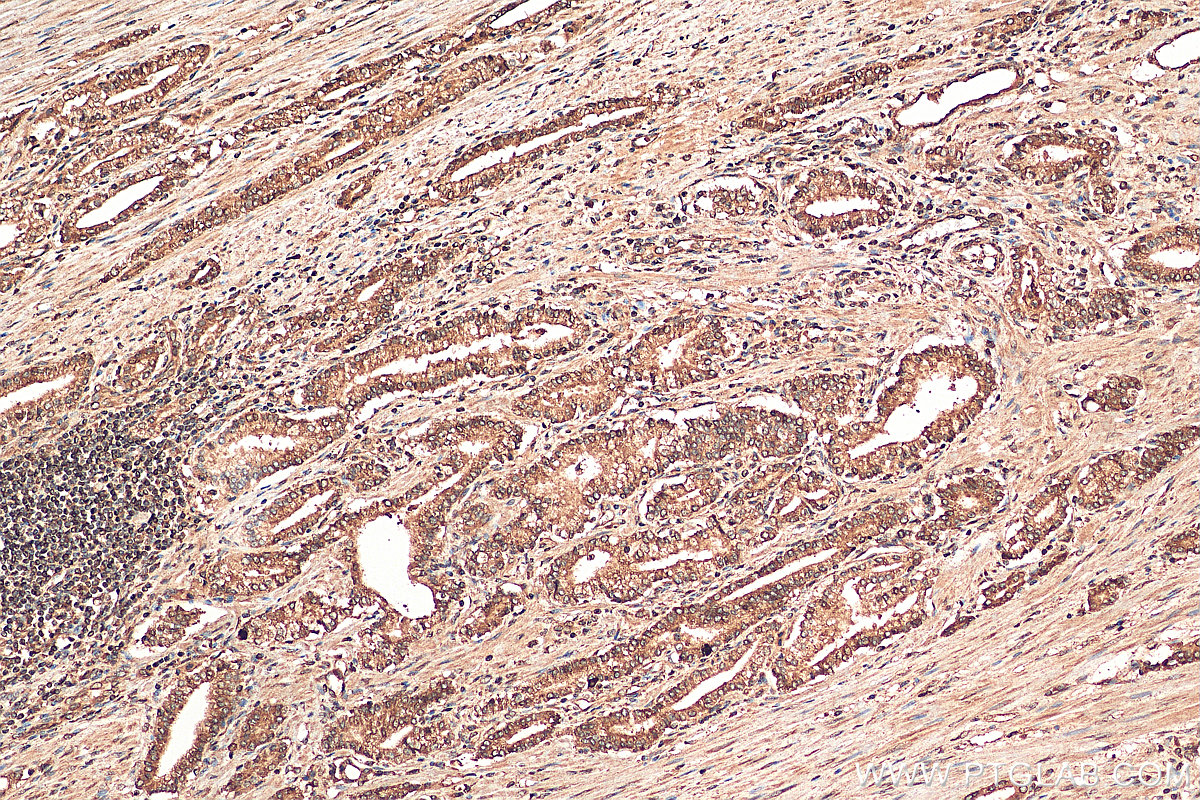 IHC staining of human prostate cancer using 26223-1-AP