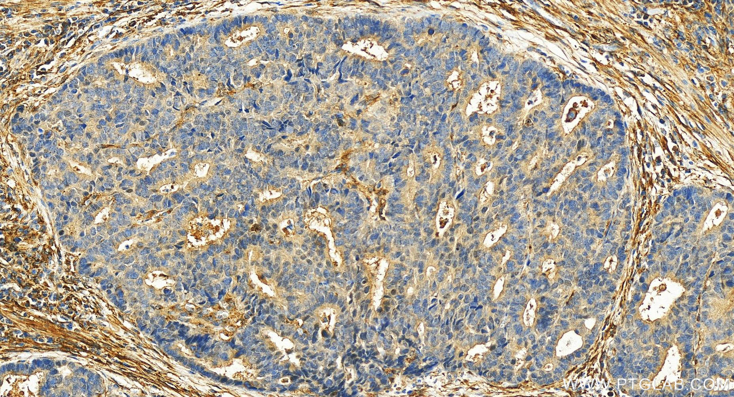 IHC staining of human stomach cancer using 27602-1-AP