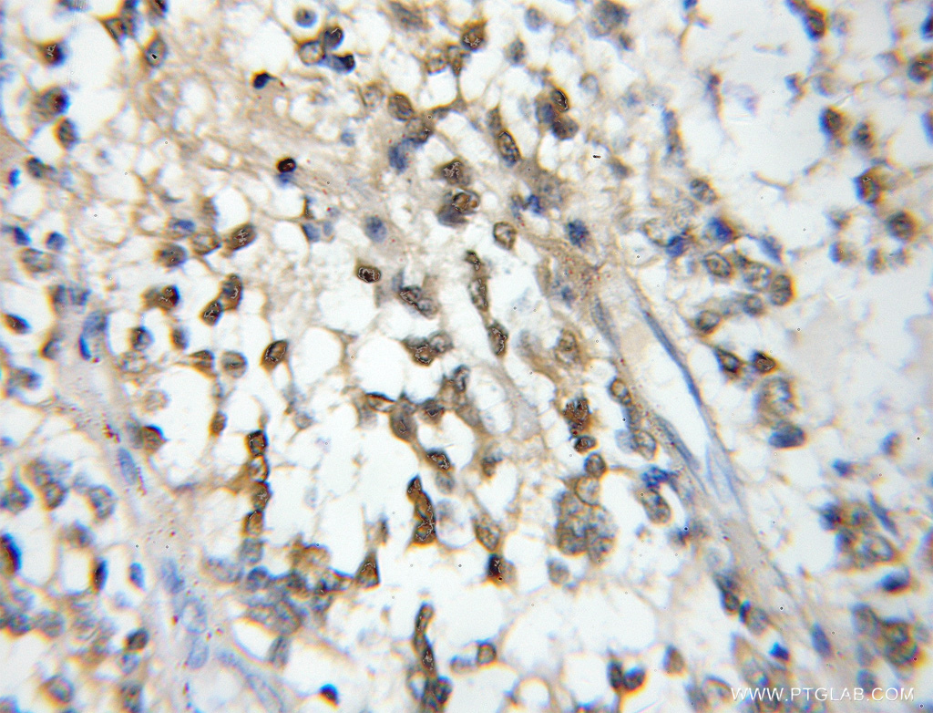 IHC staining of human gliomas using 11400-1-AP