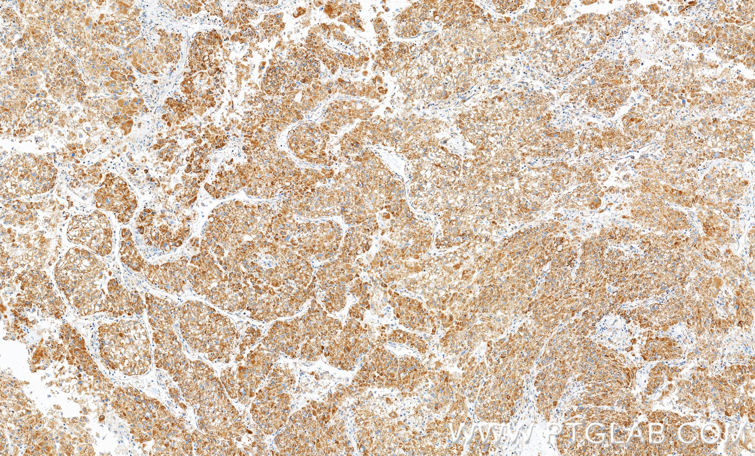 IHC staining of human liver cancer using 86461-2-RR