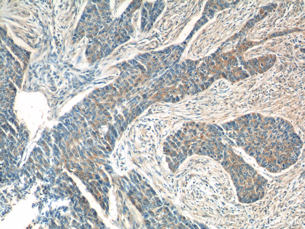 IHC staining of human skin cancer using 16610-1-AP