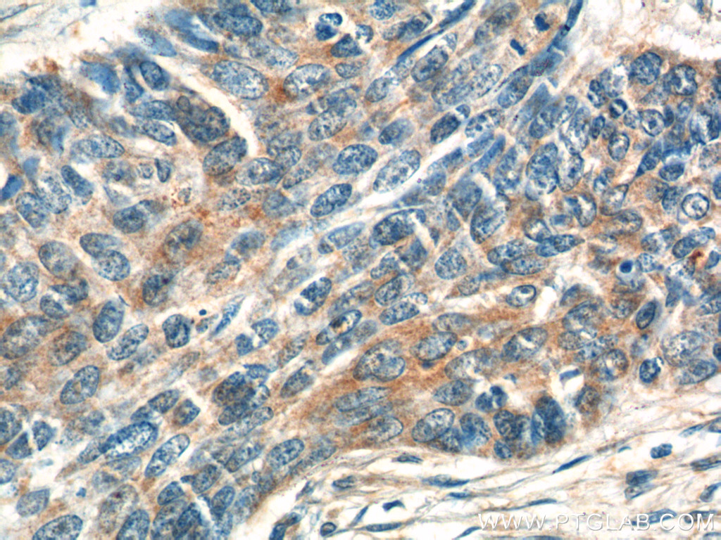 IHC staining of human skin cancer using 16610-1-AP