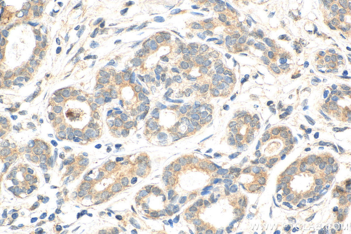 IHC staining of human breast cancer using 14834-1-AP