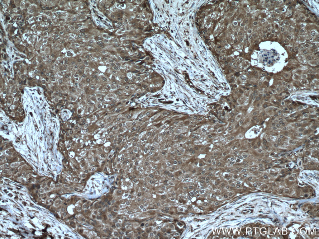 IHC staining of human breast cancer using 10835-1-AP