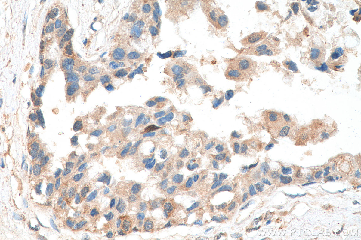 IHC staining of human breast cancer using 28657-1-AP