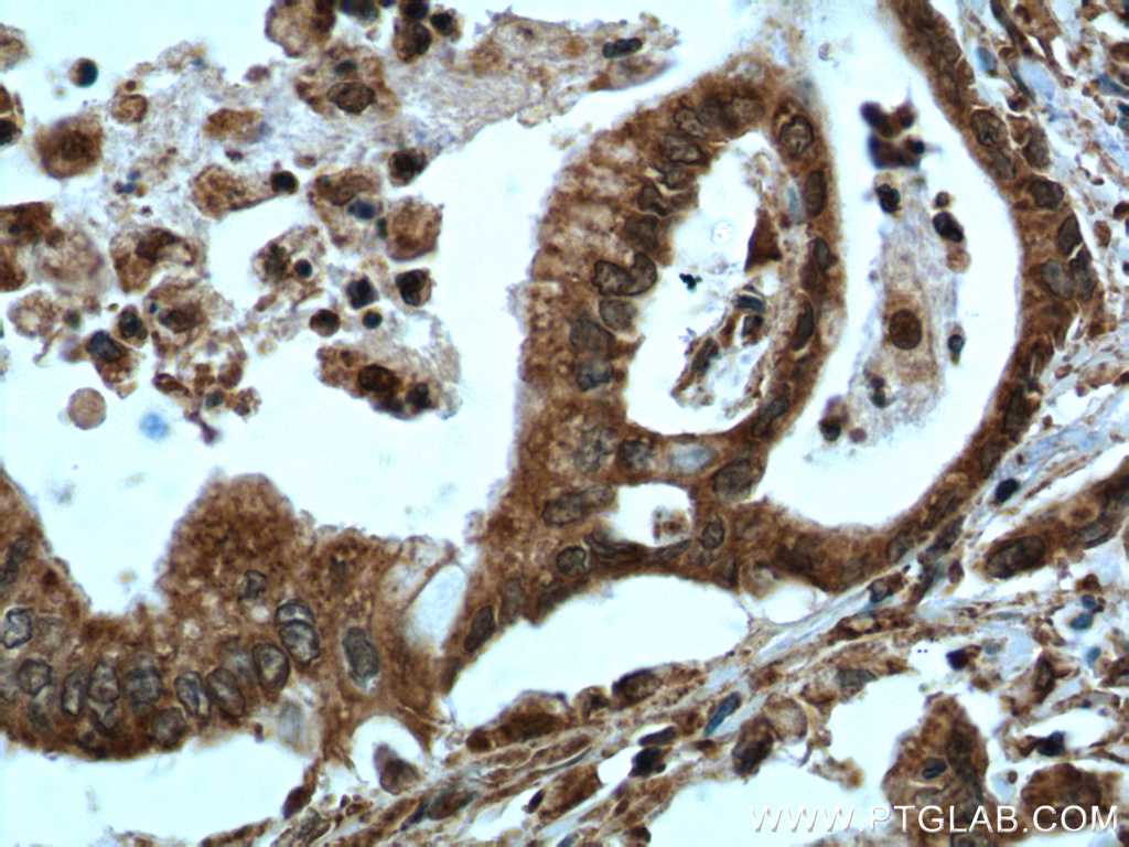 IHC staining of human pancreas cancer using 60035-1-Ig (same clone as 60035-1-PBS)