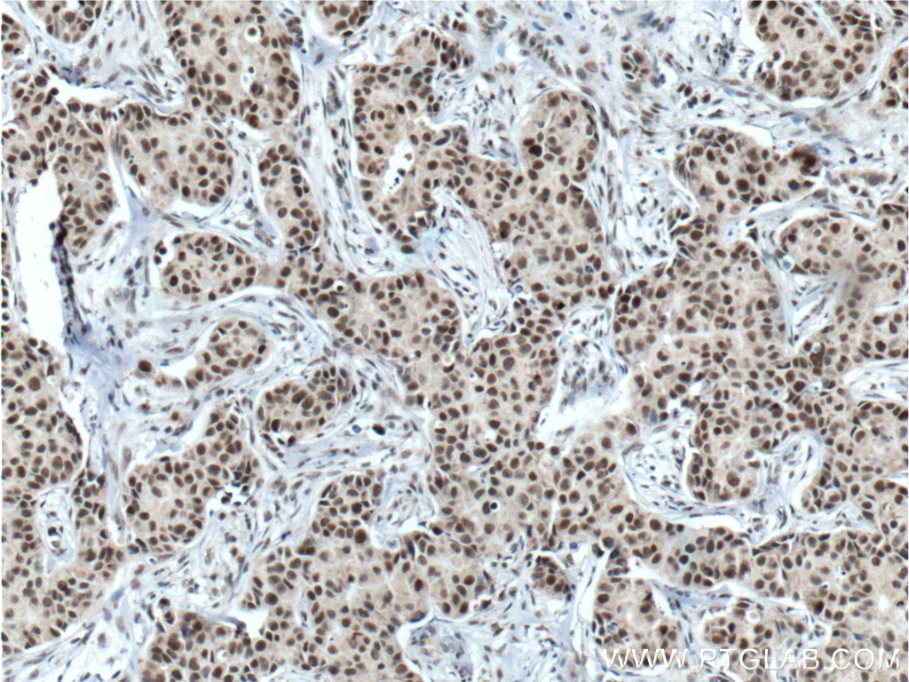 IHC staining of human breast cancer using 14699-1-AP