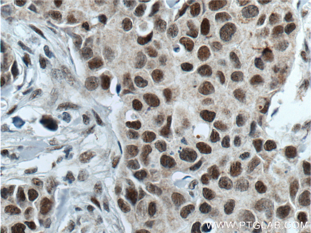 IHC staining of human breast cancer using 14699-1-AP