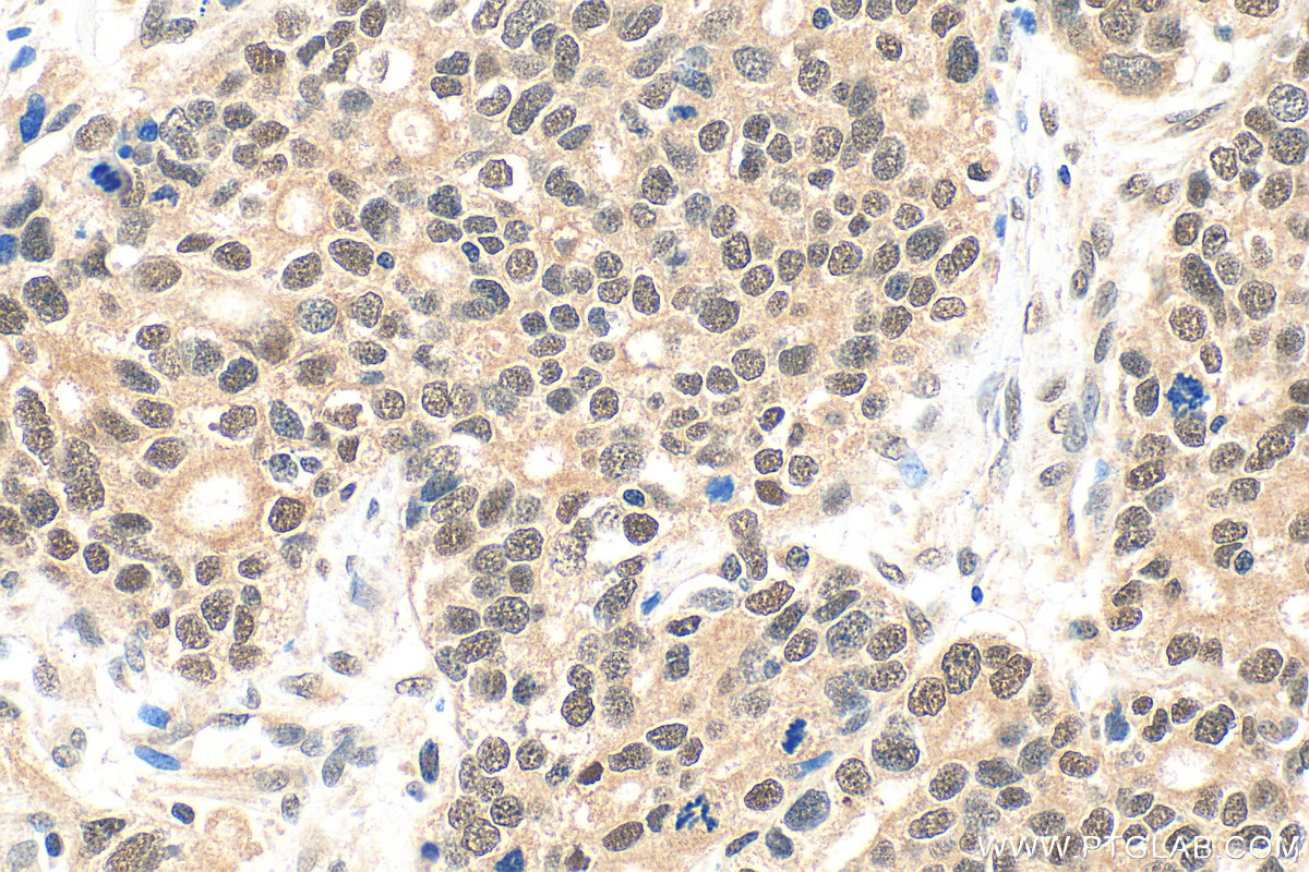 IHC staining of human ovary tumor using 14699-1-AP