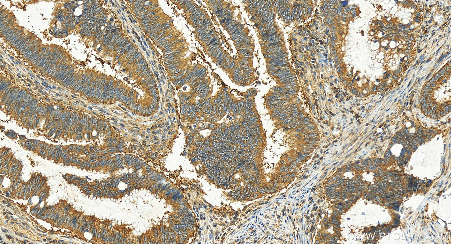 IHC staining of human colon cancer using 30505-1-AP (same clone as 30505-1-PBS)