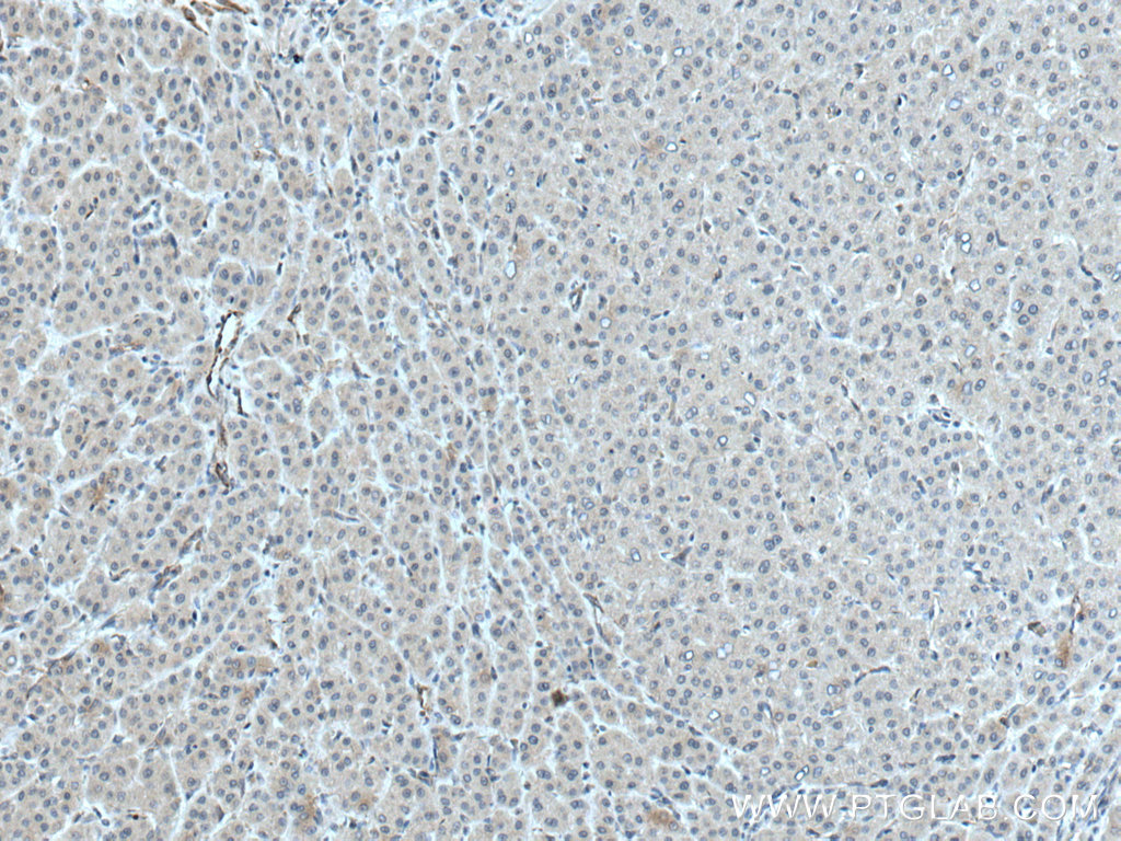 IHC staining of human liver cancer using 28021-1-AP