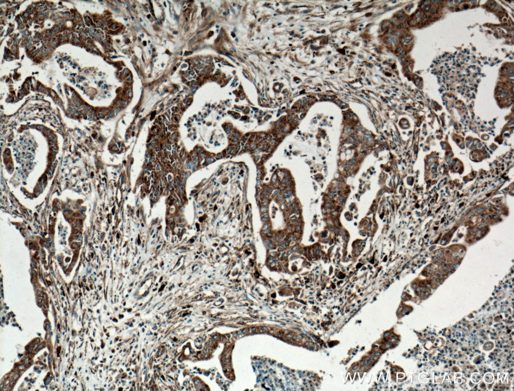 IHC staining of human pancreas cancer using 25155-1-AP