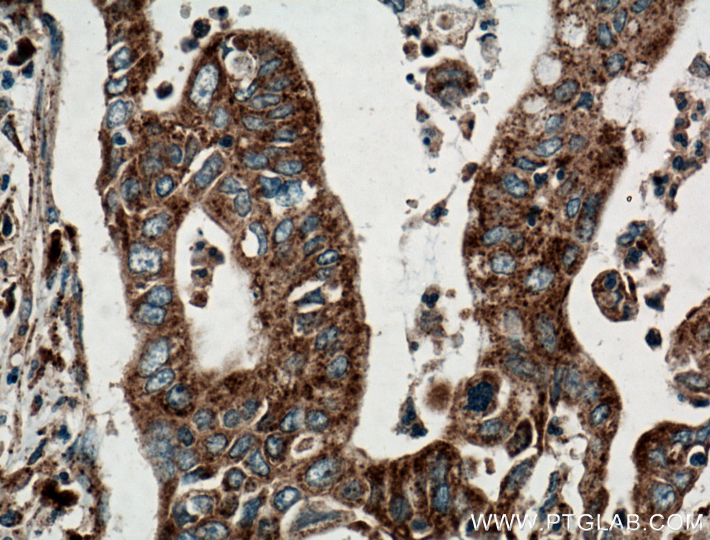 IHC staining of human pancreas cancer using 25155-1-AP