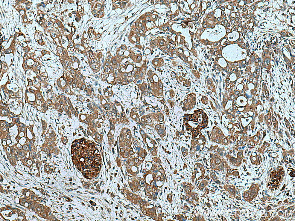 IHC staining of human pancreas cancer using 15131-1-AP