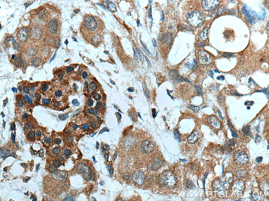 IHC staining of human pancreas cancer using 15131-1-AP