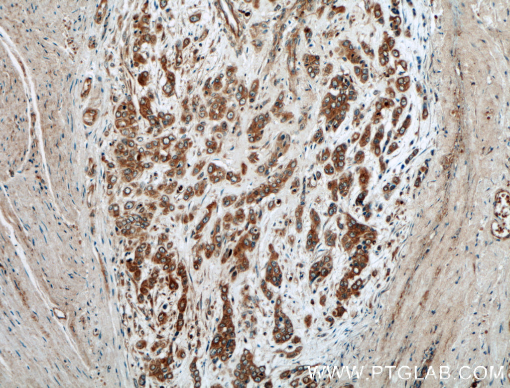 IHC staining of human colon cancer using 10181-2-AP