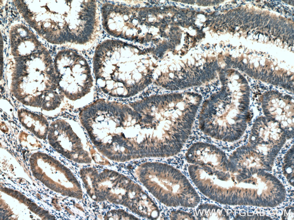 IHC staining of human colon cancer using 66744-1-Ig (same clone as 66744-1-PBS)