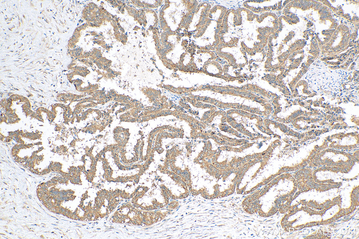IHC staining of human ovary tumor using 81803-1-RR (same clone as 81803-1-PBS)