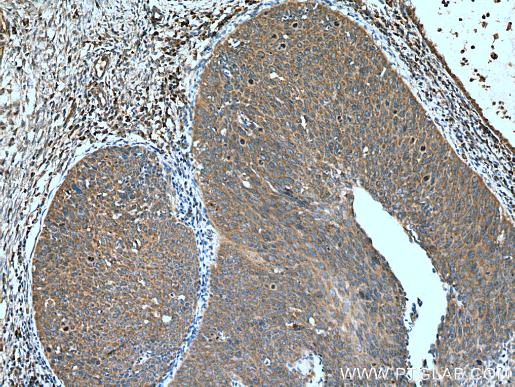 IHC staining of human cervical cancer using 10088-2-AP
