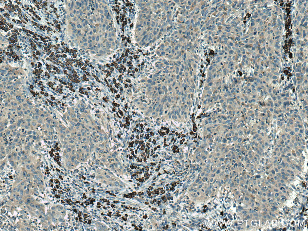 IHC staining of human cervical cancer using 28413-1-AP