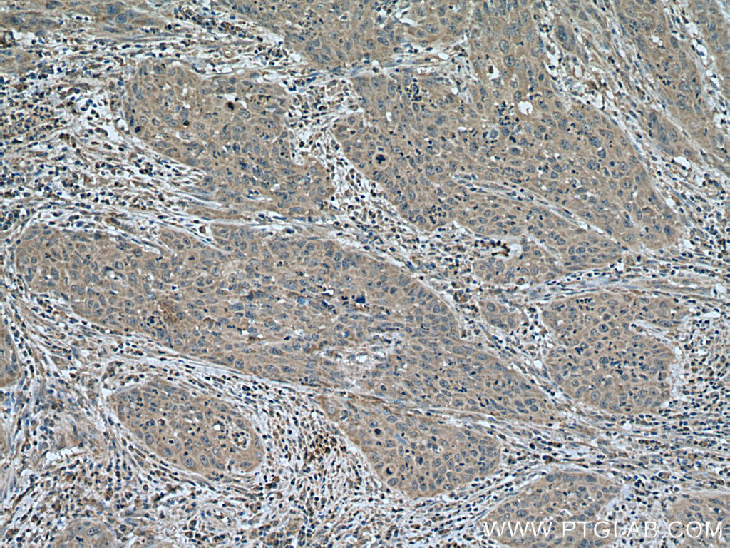 IHC staining of human cervical cancer using 67341-1-Ig (same clone as 67341-1-PBS)