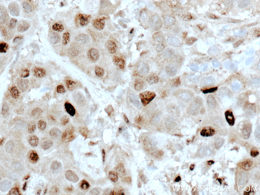 IHC staining of human breast cancer using 27156-1-AP