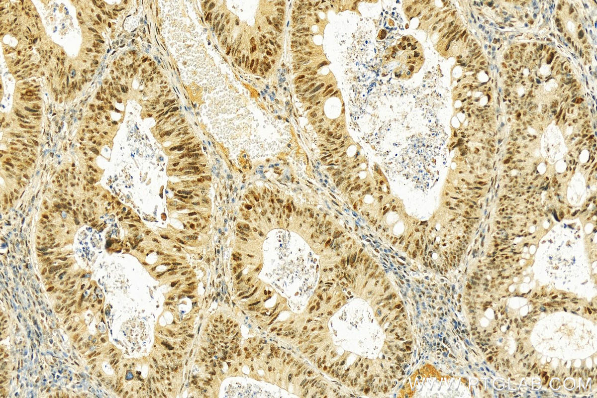 IHC staining of human colon cancer using 21215-1-AP
