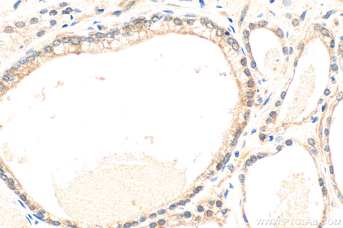 IHC staining of human prostate hyperplasia using 22641-1-AP