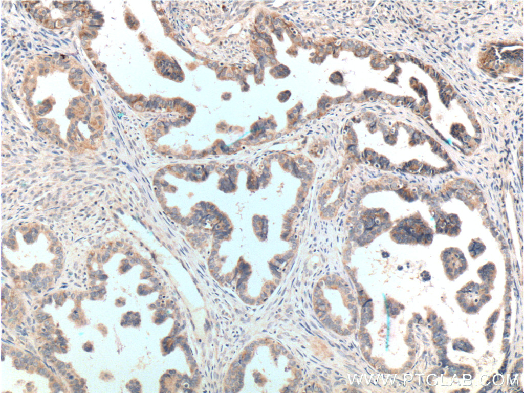 IHC staining of human ovary tumor using 13672-1-AP