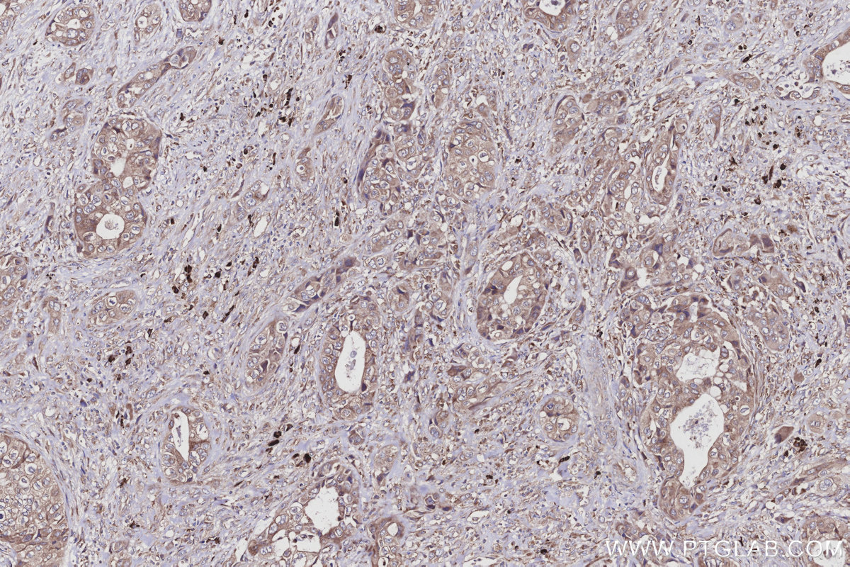 IHC staining of human pancreas cancer using 16244-1-AP IHC staining of human pancreas cancer using 16244-1-AP