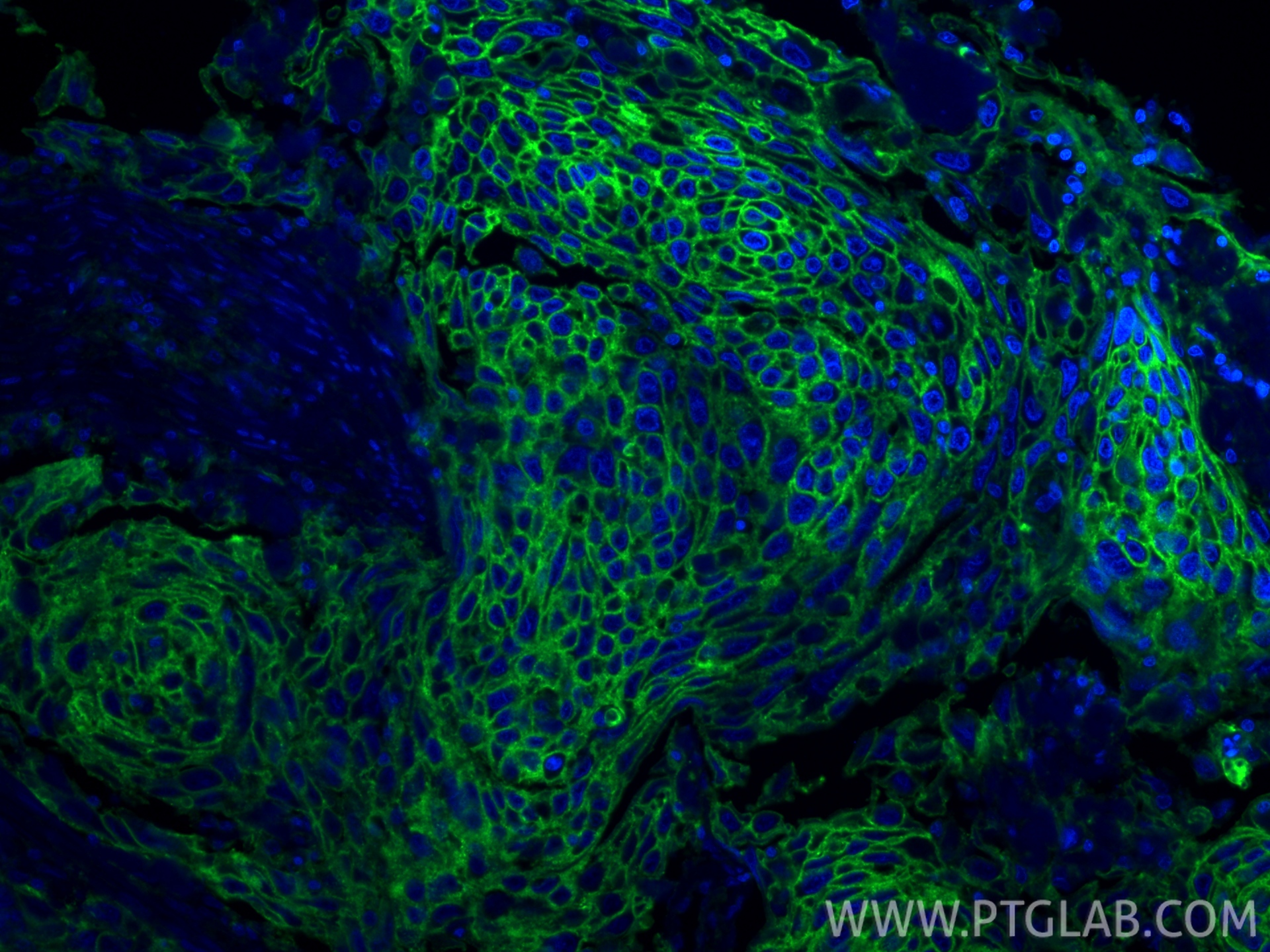 Immunofluorescent analysis of (4% PFA) fixed paraffin-embedded human cervical cancer tissue using ATP1A1 antibody (14418-1-AP) at dilution of 1:1000 and CoraLite®488-Conjugated Goat Anti-Rabbit IgG(H+L) (<a class='green' href='/productredirect?CatalogNo=SA00013-2' target='_blank'>SA00013-2</a>). Heat mediated antigen retrieval with Tris-EDTA buffer (pH 9.0). IF Staining of human cervical cancer using 14418-1-AP