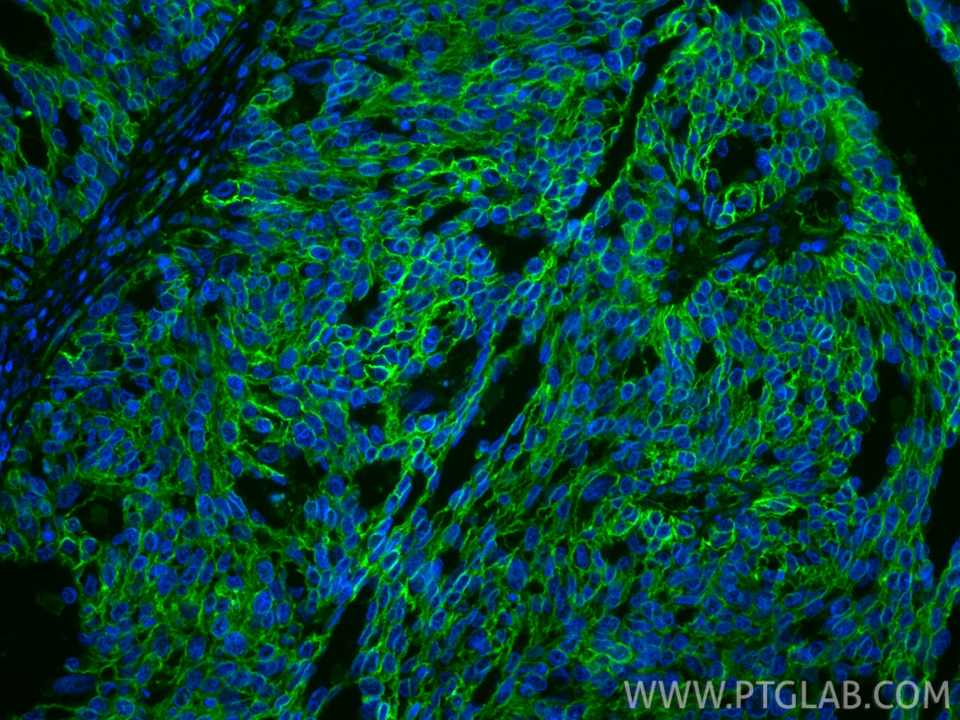 Immunofluorescent analysis of (4% PFA) fixed paraffin-embedded human ovary tumor tissue using ATP1A1 antibody (14418-1-AP) at dilution of 1:1000 and CoraLite®488-Conjugated Goat Anti-Rabbit IgG(H+L) (<a class='green' href='/productredirect?CatalogNo=SA00013-2' target='_blank'>SA00013-2</a>). Heat mediated antigen retrieval with Tris-EDTA buffer (pH 9.0). IF Staining of human ovary tumor using 14418-1-AP